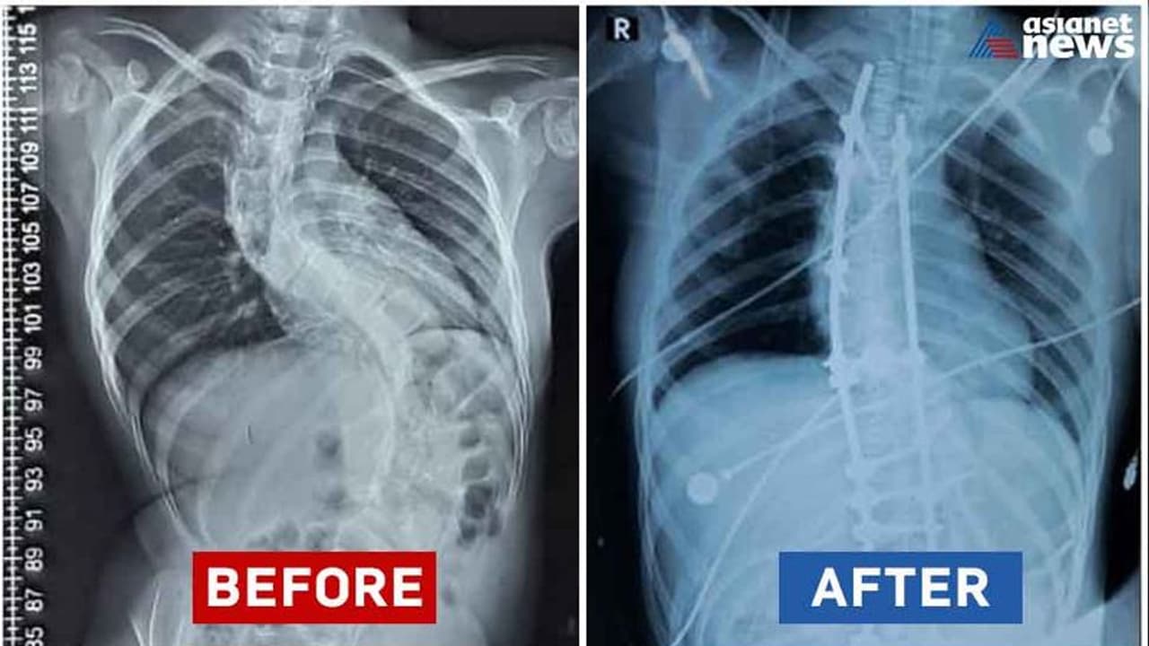എപിഫൈസിയല്‍ ഡിസ്‌പ്ലേസിയ ബാധിച്ച കുഞ്ഞ് ഫാത്തിമ; നവകേരള സദസ് തലസ്ഥാനത്ത് അവസാനിക്കുമ്പോൾ നിവർന്ന് നടക്കും!