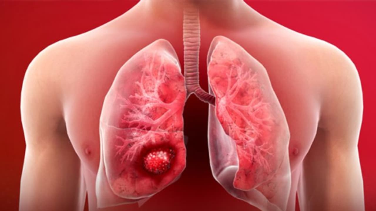 തിരിച്ചറിയാം ലങ് ക്യാൻസറിന്റെ പ്രധാനപ്പെട്ട മൂന്ന് ലക്ഷണങ്ങൾ... തിരിച്ചറിയാം ലങ് ക്യാൻസറിന്റെ പ്രധാനപ്പെട്ട മൂന്ന് ലക്ഷണങ്ങൾ...