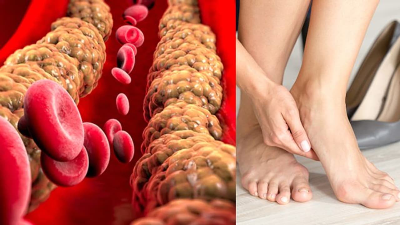 കാലുകളില് കാണുന്ന ഈ ലക്ഷണങ്ങള് ചീത്ത കൊളസ്ട്രോളിന്റെയാകാം... കാലുകളില് കാണുന്ന ഈ ലക്ഷണങ്ങള് ചീത്ത കൊളസ്ട്രോളിന്റെയാകാം...