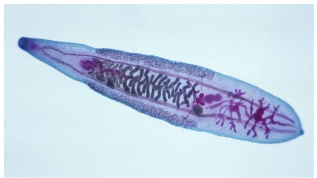 70 കാരന് കഠിനമായ വയറുവേദന, പരിശോധനയില്‍ കണ്ടത് ട്യൂമര്‍; ശസ്ത്രക്രിയയിലൂടെ നീക്കം ചെയ്തത് 5 വിരകളെ !