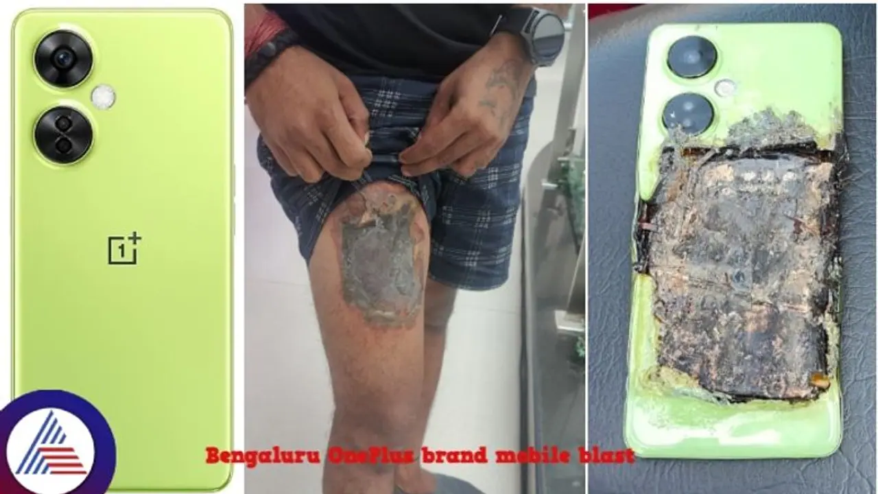 ಹೊಸ ಒನ್‌ಪ್ಲಸ್ ಮೊಬೈಲ್‌ ಬ್ಲಾಸ್ಟ್‌: ಬೆಂಗಳೂರು ಯುವಕನ ತೊಡೆ ಭಾಗ ಊಸ್ಟ್‌!