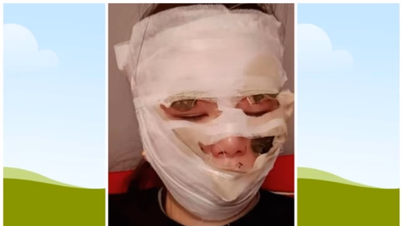 അതിഥികള് വിവാഹം 'ആഘോഷിച്ചു'; വിവാഹ ദിനം മുഖത്ത് ഗുരുതരമായി പൊള്ളലേറ്റ വധു ആശുപത്രിയില് ! അതിഥികള് വിവാഹം 'ആഘോഷിച്ചു'; വിവാഹ ദിനം മുഖത്ത് ഗുരുതരമായി പൊള്ളലേറ്റ വധു ആശുപത്രിയില് !