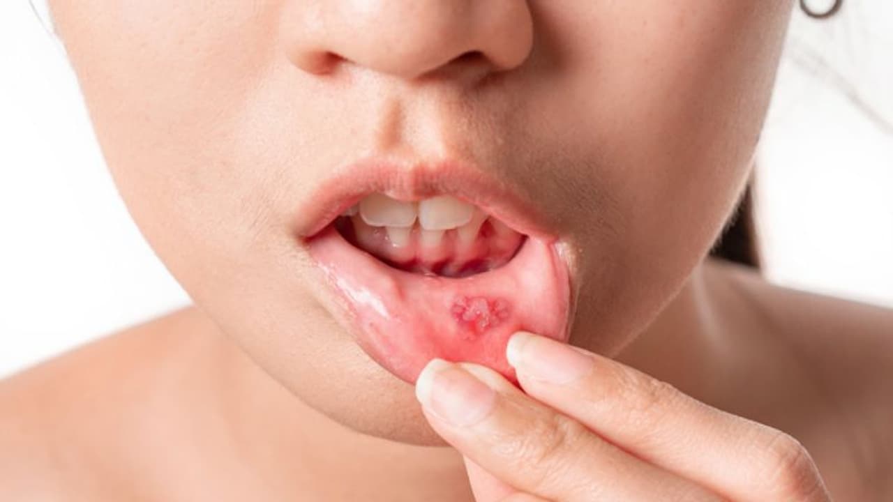 വായ്പ്പുണ്ണ് സ്ഥിരമായി വരാറുണ്ടോ? എങ്കില്, ഉറപ്പായും നിങ്ങള് ഇത് അറിഞ്ഞിരിക്കണം... വായ്പ്പുണ്ണ് സ്ഥിരമായി വരാറുണ്ടോ? എങ്കില്, ഉറപ്പായും നിങ്ങള് ഇത് അറിഞ്ഞിരിക്കണം...