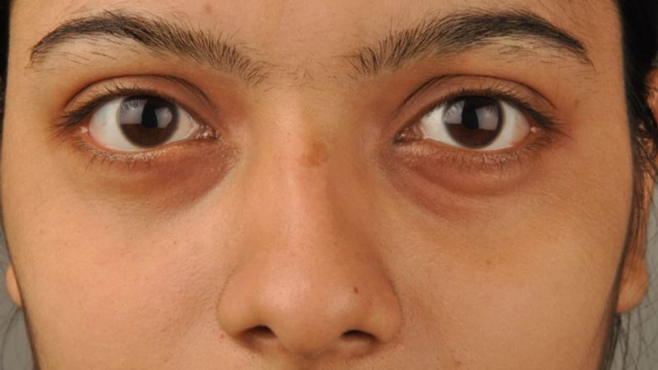 കൺതടങ്ങളിലെ ഇരുണ്ട നിറം; അറിയാം കാരണങ്ങളും പൊടിക്കൈകളും... കൺതടങ്ങളിലെ ഇരുണ്ട നിറം; അറിയാം കാരണങ്ങളും പൊടിക്കൈകളും...