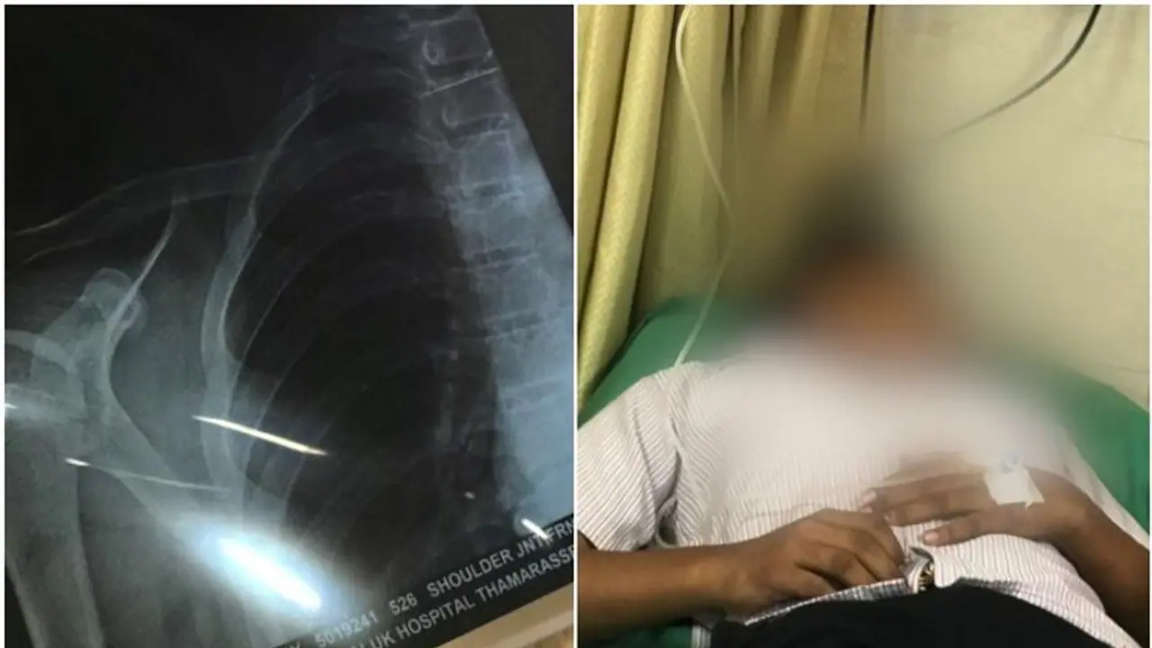 യൂണിഫോമിന്റെ ബട്ടന്‍ ഇടണമെന്ന് പറഞ്ഞ് സീനിയർ വിദ്യാർത്ഥികളുടെ മർദനം; പ്ലസ് വൺ വിദ്യാർത്ഥിയുടെ തോളെല്ല് പൊട്ടി