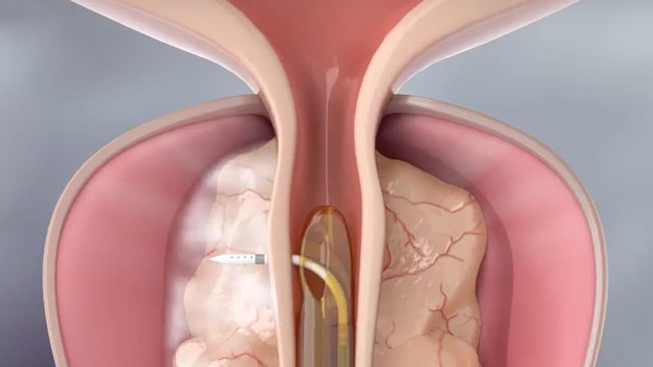 പ്രോസ്റ്റേറ്റ് വീക്കത്തിന് റീസം വാട്ടർ തെറപ്പി; ദക്ഷിണേന്ത്യയിൽ ആദ്യമെന്ന് ആസ്റ്റർ മെഡ്സിറ്റി പ്രോസ്റ്റേറ്റ് വീക്കത്തിന് റീസം വാട്ടർ തെറപ്പി; ദക്ഷിണേന്ത്യയിൽ ആദ്യമെന്ന് ആസ്റ്റർ മെഡ്സിറ്റി