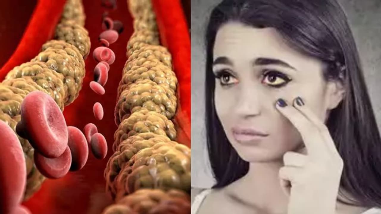 ശരീരത്തിലെ ഈ മൂന്ന് ഇടങ്ങളിലെ ലക്ഷണങ്ങള് ചീത്ത കൊളസ്ട്രോളിന്റെയാകാം... ശരീരത്തിലെ ഈ മൂന്ന് ഇടങ്ങളിലെ ലക്ഷണങ്ങള് ചീത്ത കൊളസ്ട്രോളിന്റെയാകാം...