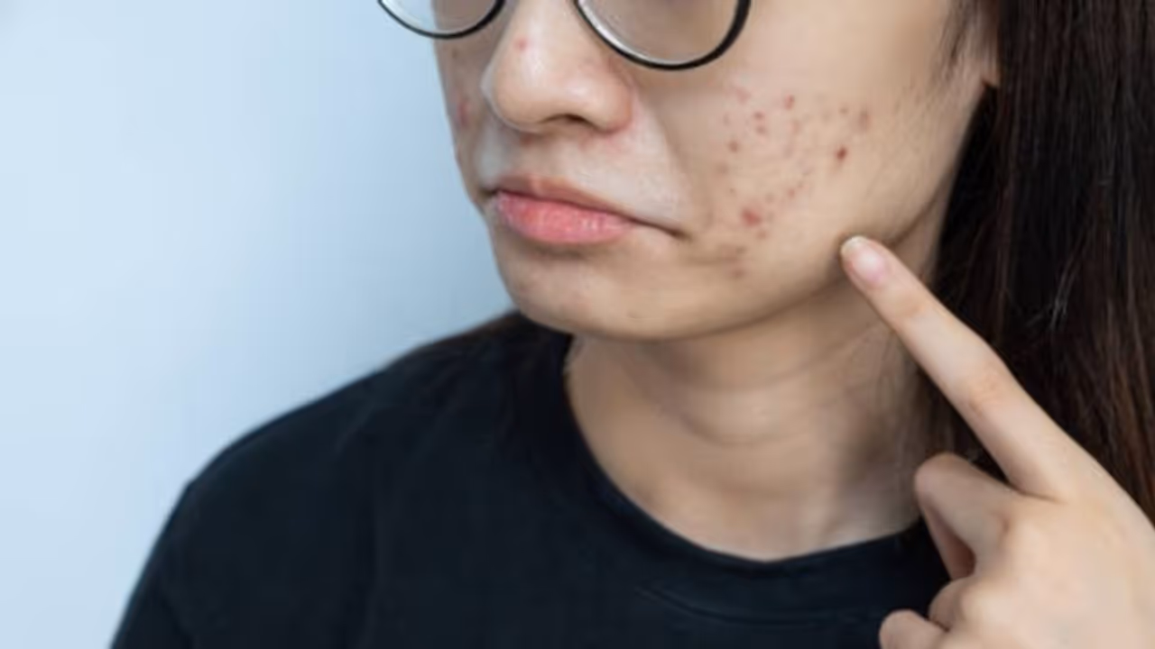 മുഖക്കുരുവിന്റെ പാട് മാറാൻ എളുപ്പത്തില് ചെയ്യാവുന്ന പൊടിക്കൈകള് മുഖക്കുരുവിന്റെ പാട് മാറാൻ എളുപ്പത്തില് ചെയ്യാവുന്ന പൊടിക്കൈകള്