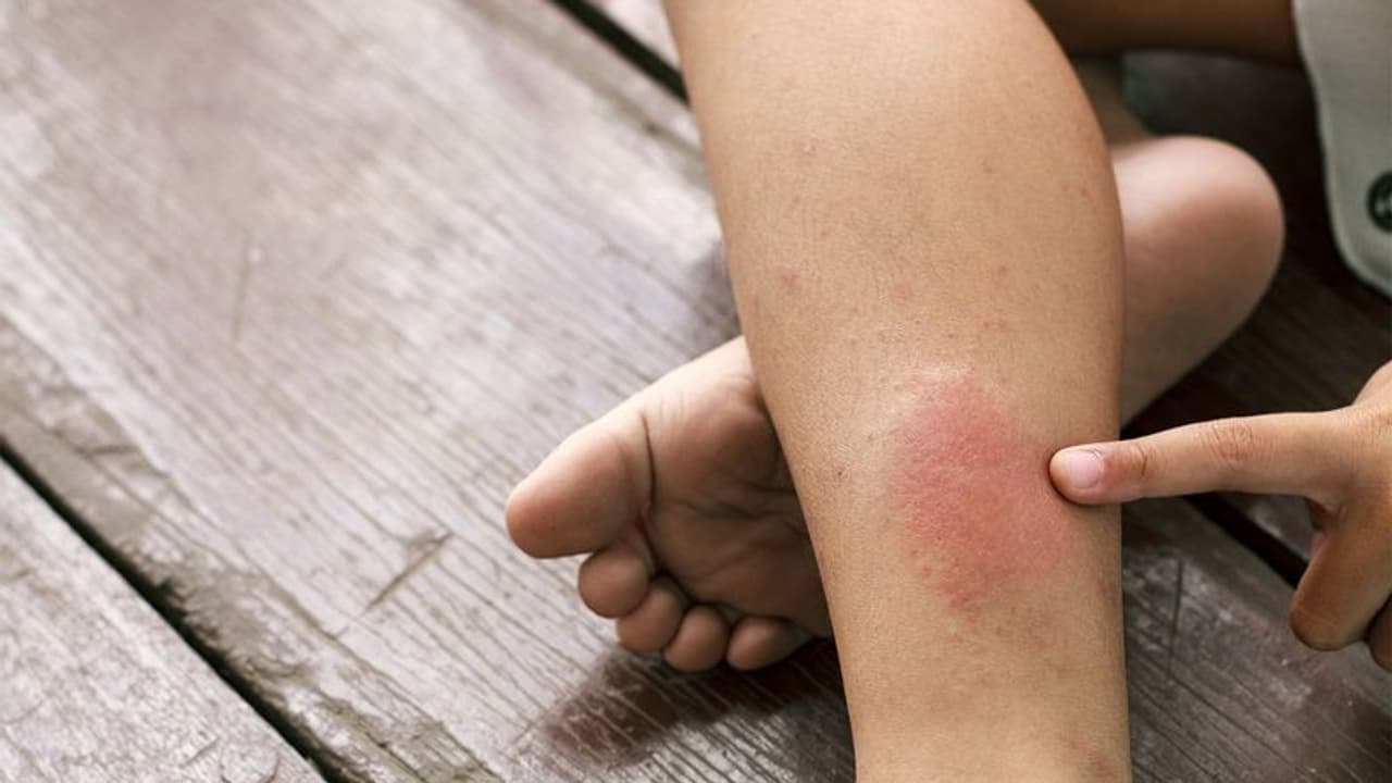 രക്തം കട്ടപിടിക്കുന്നത് ; ഇക്കാര്യങ്ങൾ അറിഞ്ഞിരിക്കൂ രക്തം കട്ടപിടിക്കുന്നത് ; ഇക്കാര്യങ്ങൾ അറിഞ്ഞിരിക്കൂ