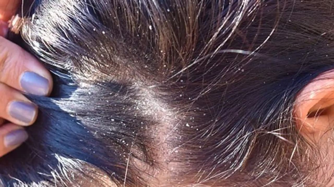 താരൻ എളുപ്പം അകറ്റാം; പരീക്ഷിക്കാം ഈ ഏഴ് പൊടിക്കൈകള്... താരൻ എളുപ്പം അകറ്റാം; പരീക്ഷിക്കാം ഈ ഏഴ് പൊടിക്കൈകള്...