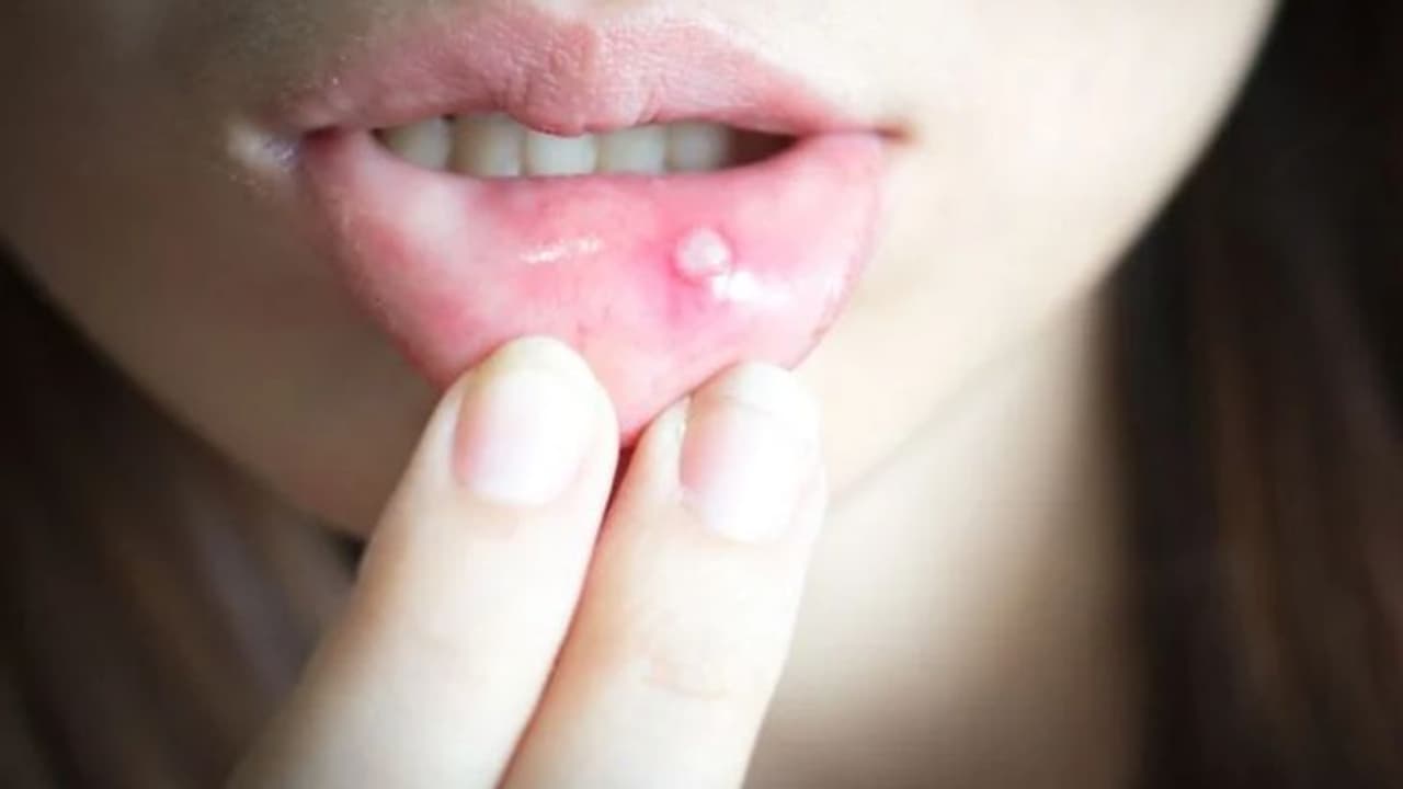 വായ്പ്പുണ്ണ് സ്ഥിരമായി വരാറുണ്ടോ? എങ്കില്‍, ഈ ഭക്ഷണങ്ങള്‍ ഒഴിവാക്കൂ... 