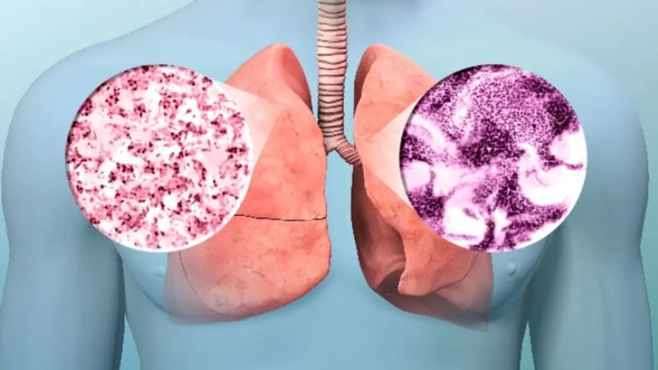 Lung cancer: धीरे धीरे लाखों जिंदगी निगल रहा लंग कैंसर, कहीं आप भी तो नहीं कर रहे ये गलतियां Lung cancer: धीरे धीरे लाखों जिंदगी निगल रहा लंग कैंसर, कहीं आप भी तो नहीं कर रहे ये गलतियां