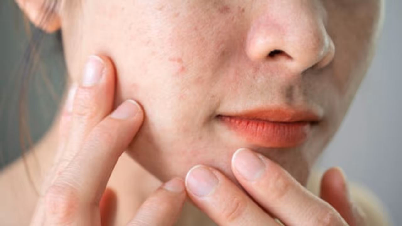 മുഖത്ത് വരുന്ന നിറം മാറ്റത്തിന് പിന്നിലെ കാരണങ്ങള്; ഒരു പരിഹാരവും... മുഖത്ത് വരുന്ന നിറം മാറ്റത്തിന് പിന്നിലെ കാരണങ്ങള്; ഒരു പരിഹാരവും...