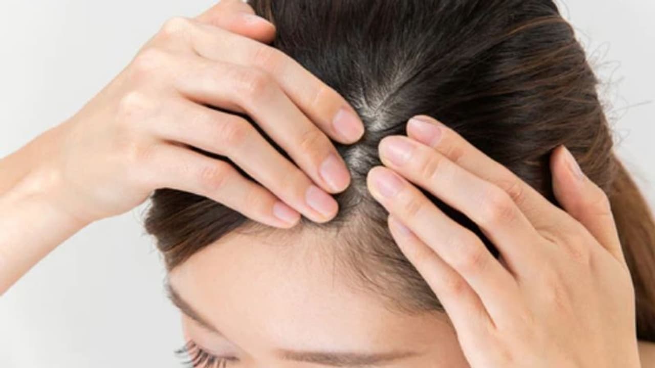 തലയോട്ടിയിലെ സോറിയാസിസ്; ഈ ലക്ഷണങ്ങളെ നിസാരമായി കാണരുത്... തലയോട്ടിയിലെ സോറിയാസിസ്; ഈ ലക്ഷണങ്ങളെ നിസാരമായി കാണരുത്...