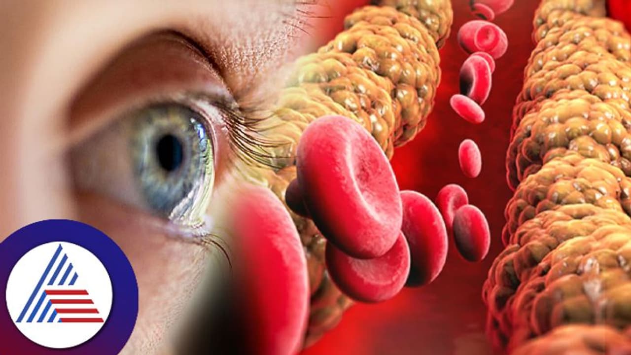 Health tips: ಕೊಲೆಸ್ಟ್ರಾಲ್ ಹೆಚ್ಚಾದಾಗ ಕಣ್ಣಲ್ಲಾಗುವ ಈ ಬದಲಾವಣೆ ನಿಮ್ಮನ್ನು ಕುರುಡು ಮಾಡ್ಬಹುದು… Health tips: ಕೊಲೆಸ್ಟ್ರಾಲ್ ಹೆಚ್ಚಾದಾಗ ಕಣ್ಣಲ್ಲಾಗುವ ಈ ಬದಲಾವಣೆ ನಿಮ್ಮನ್ನು ಕುರುಡು ಮಾಡ್ಬಹುದು…