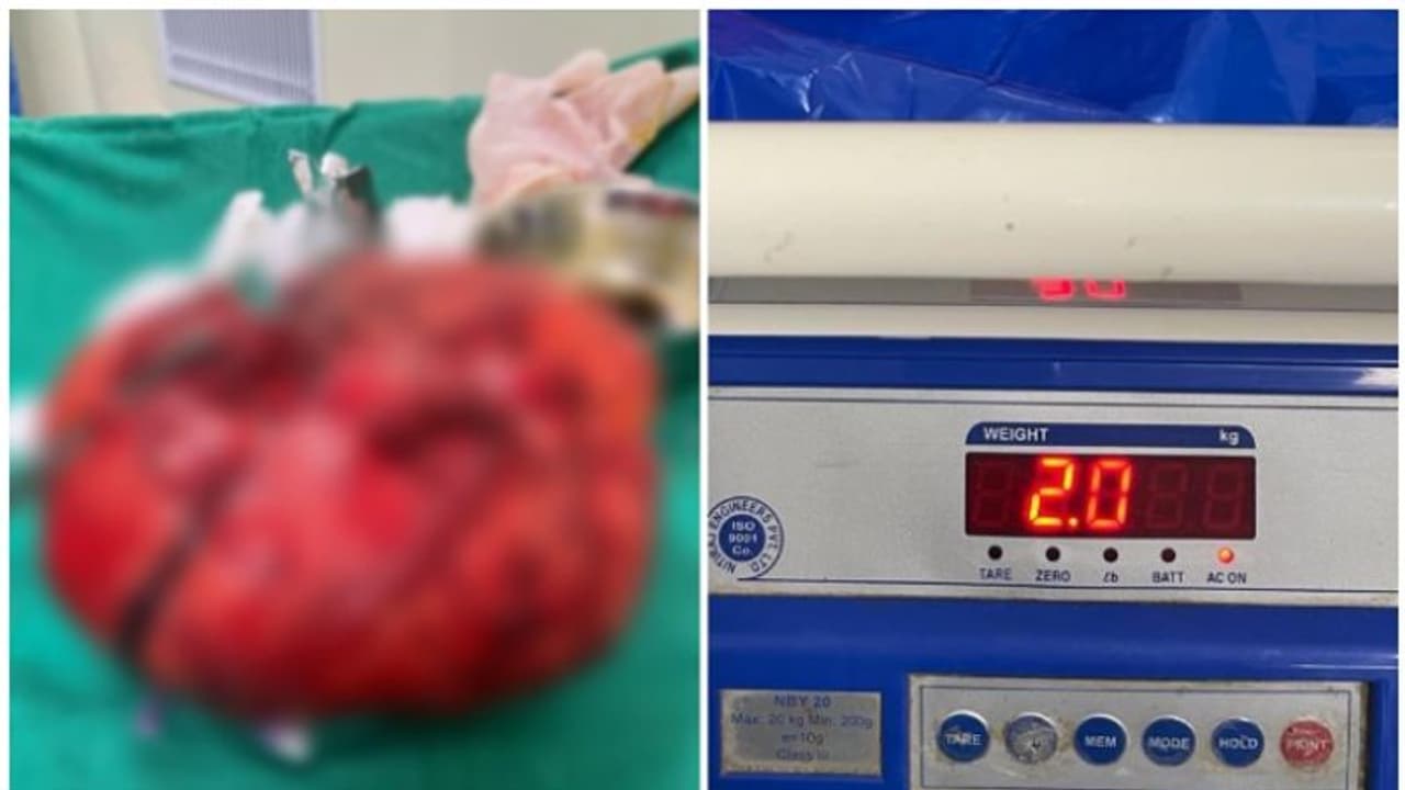 60കാരന്റ കഴുത്തിൽ പത്ത് വർഷമായി വളരുന്ന മുഴ, 2 കിലോ ഭാരം; താലൂക്ക് ആശുപത്രിയിലെ ശസ്ത്രക്രിയയിൽ നീക്കം ചെയ്തു 60കാരന്റ കഴുത്തിൽ പത്ത് വർഷമായി വളരുന്ന മുഴ, 2 കിലോ ഭാരം; താലൂക്ക് ആശുപത്രിയിലെ ശസ്ത്രക്രിയയിൽ നീക്കം ചെയ്തു