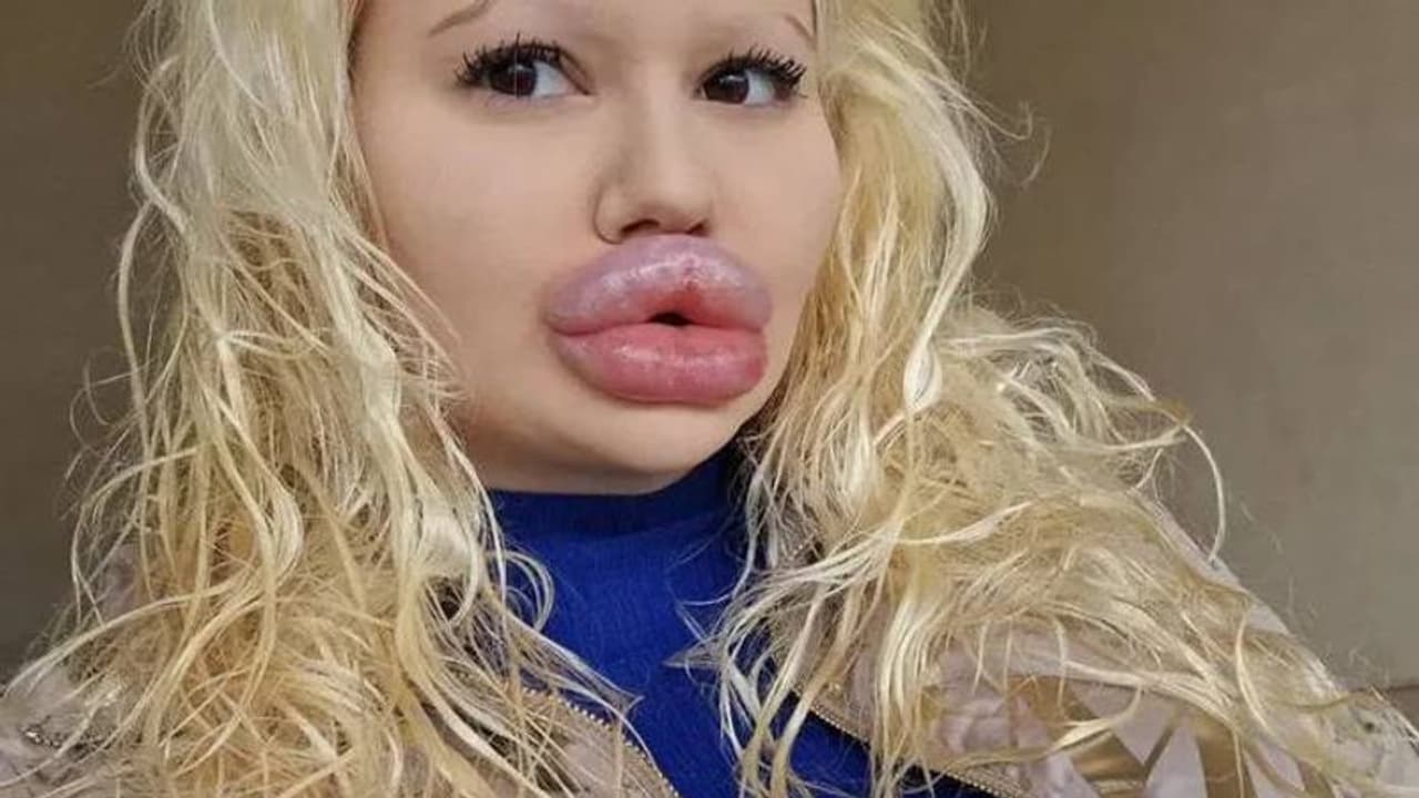 ലോകത്തിലെ ഏറ്റവും വലിയ ചുണ്ടുള്ള സ്ത്രീ, ചെലവാക്കിയത് 21 ലക്ഷം, ഒടുവില് ഡോക്ടറും പറഞ്ഞു, നോ..! ലോകത്തിലെ ഏറ്റവും വലിയ ചുണ്ടുള്ള സ്ത്രീ, ചെലവാക്കിയത് 21 ലക്ഷം, ഒടുവില് ഡോക്ടറും പറഞ്ഞു, നോ..!