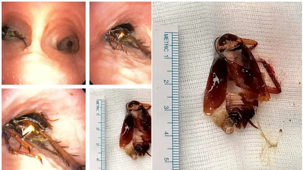 കടുത്ത ശ്വാസതടസം, കൊച്ചിയിൽ ചികിത്സ തേടിയെത്തിയ 55 കാരന്റ ശ്വാസകോശത്തിൽ നിന്ന് പുറത്തെടുത്തത് പാറ്റയെ...