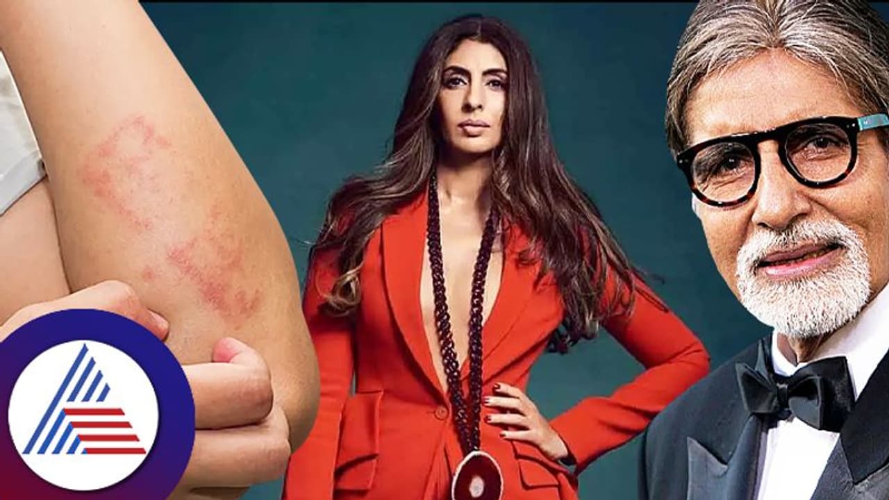 ಅಮಿತಾಬ್ ಬಚ್ಚನ್ ಮಗಳು ಶ್ವೇತಾಗೆ ಈ ಚರ್ಮ ಸಮಸ್ಯೆ ಇದೆಯಂತೆ! ಏನದು?