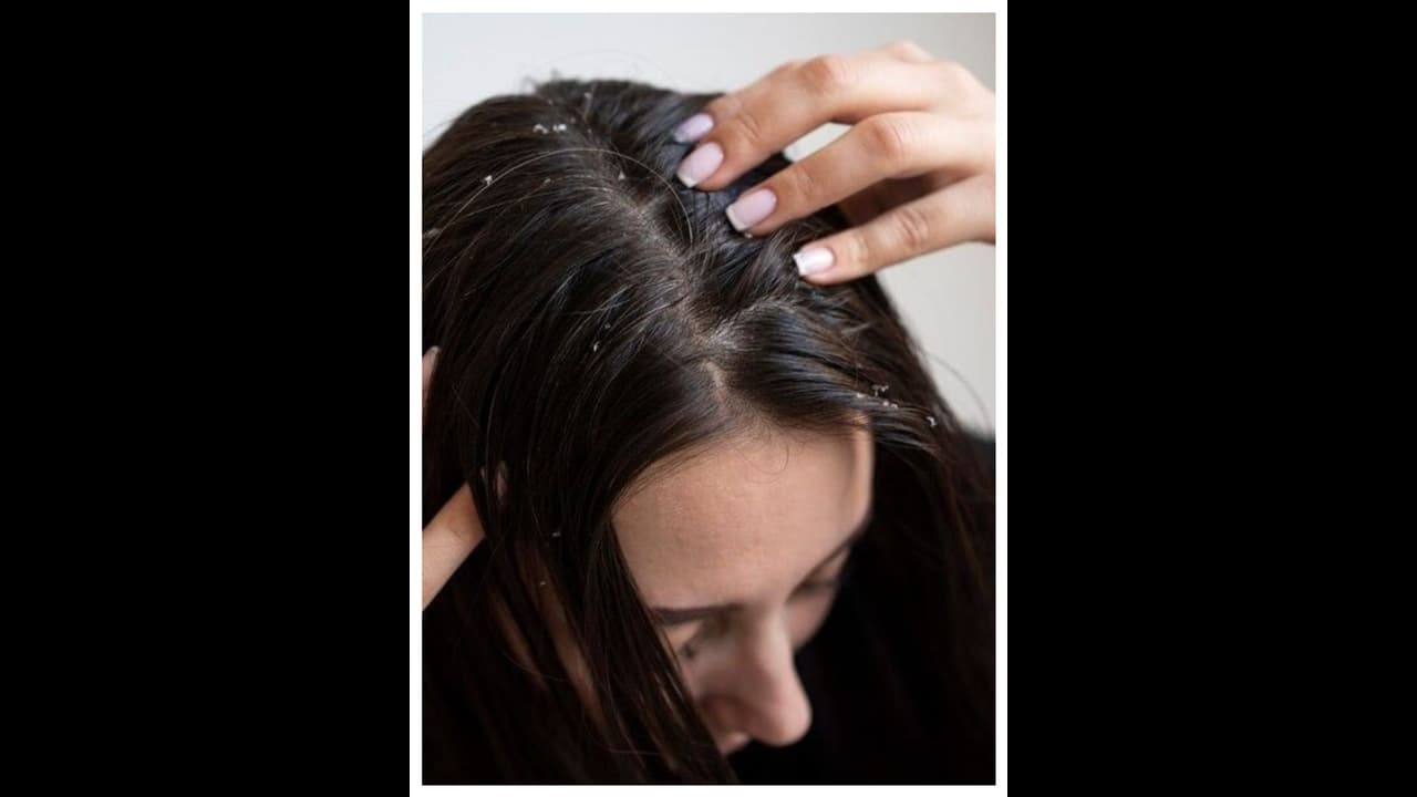 താരൻ അകറ്റാൻ പരീക്ഷിക്കാം ഈ പ്രകൃതിദത്ത മാർ​ഗങ്ങൾ