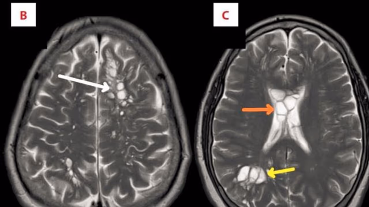 ಮೈಗ್ರೇನ್ ತಲೆನೋವು ಅಂತ ಆಸ್ಪತ್ರೆಗೆ ಹೋದವನಿಗೆ ಶಾಕ್: ಮೆದುಳಿನಲ್ಲಿ ಇದ್ದಿದ್ದೇನು ನೋಡಿ?