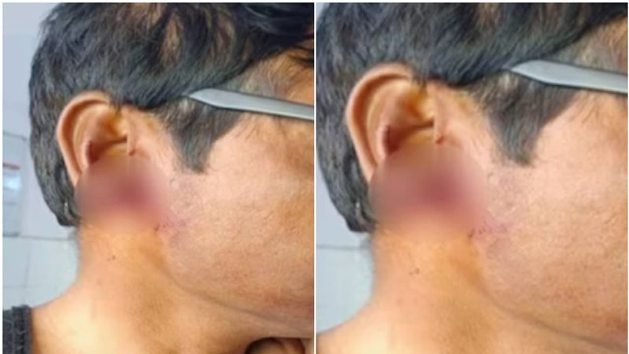 ആദ്യം തർക്കം, പിന്നാലെ രോഷാകുലയായ യുവതി അയൽവാസിയുടെ ചെവിയുടെ ഒരുഭാഗം കടിച്ചുമുറിച്ച് വിഴുങ്ങി, കാരണമിത് ! ആദ്യം തർക്കം, പിന്നാലെ രോഷാകുലയായ യുവതി അയൽവാസിയുടെ ചെവിയുടെ ഒരുഭാഗം കടിച്ചുമുറിച്ച് വിഴുങ്ങി, കാരണമിത് !