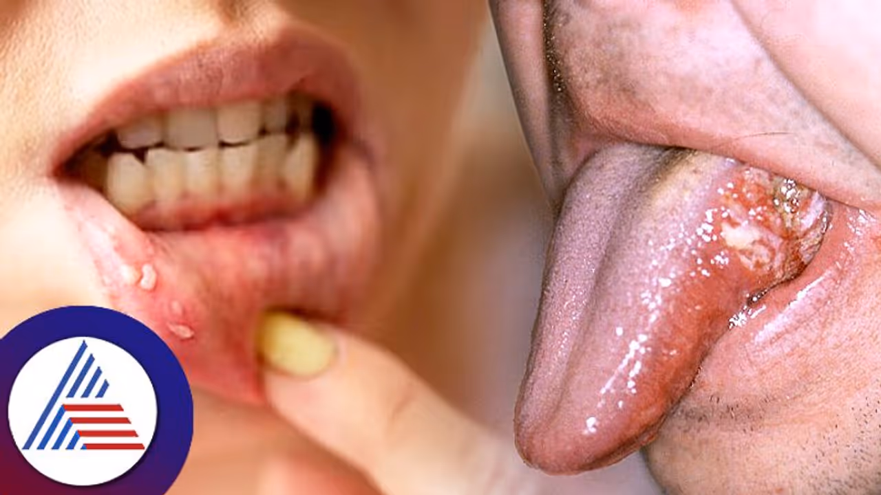 Oral Cancer : ಆರಂಭದಲ್ಲೇ ಪತ್ತೆಯಾದ್ರೆ ಗುಣಪಡಿಸಬಲ್ಲ ಬಾಯಿ ಕ್ಯಾನ್ಸರ್ ಲಕ್ಷಣವೇನು? 