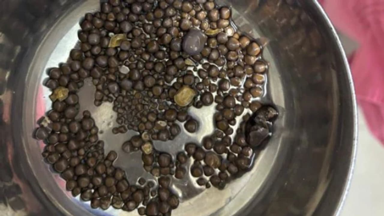 60 വയസുള്ള രോഗിയുടെ വൃക്കയില് നിന്ന് ഡോക്ടര്മാര് നീക്കിയത് 418 കല്ലുകള് 60 വയസുള്ള രോഗിയുടെ വൃക്കയില് നിന്ന് ഡോക്ടര്മാര് നീക്കിയത് 418 കല്ലുകള്