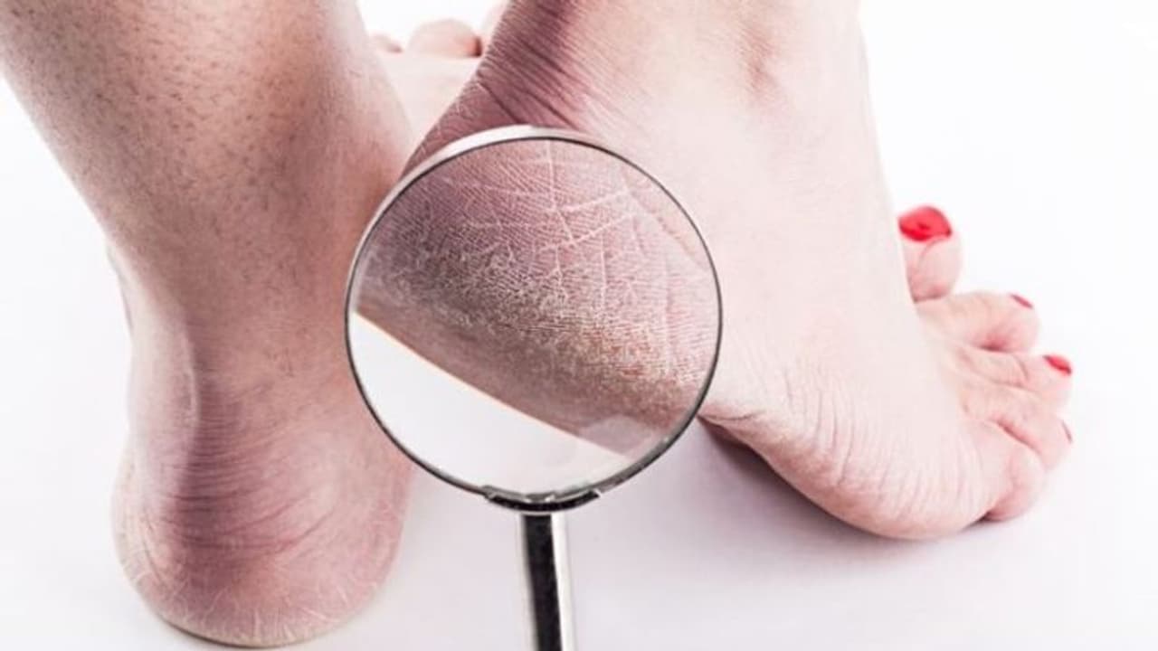 2 दिन में ठीक हो जाएगी फटी एड़ियां, बस करना होगा यह काम