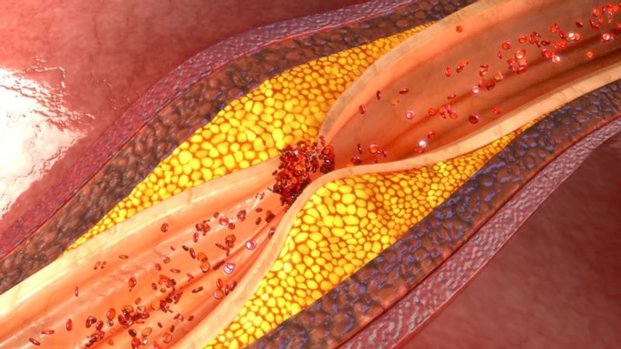 ഉയർന്ന കൊളസ്ട്രോൾ കുറയ്ക്കാൻ വീട്ടിലുണ്ട് നാല് പ്രതിവിധികൾ 