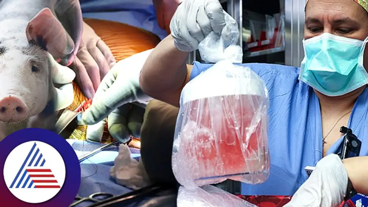 Kidney Transplant : ಇದೇ ಮೊದಲ ಬಾರಿ ಮನುಷ್ಯನಿಗೆ ಕಸಿಯಾಯ್ತು ಹಂದಿ ಕಿಡ್ನಿ Kidney Transplant : ಇದೇ ಮೊದಲ ಬಾರಿ ಮನುಷ್ಯನಿಗೆ ಕಸಿಯಾಯ್ತು ಹಂದಿ ಕಿಡ್ನಿ