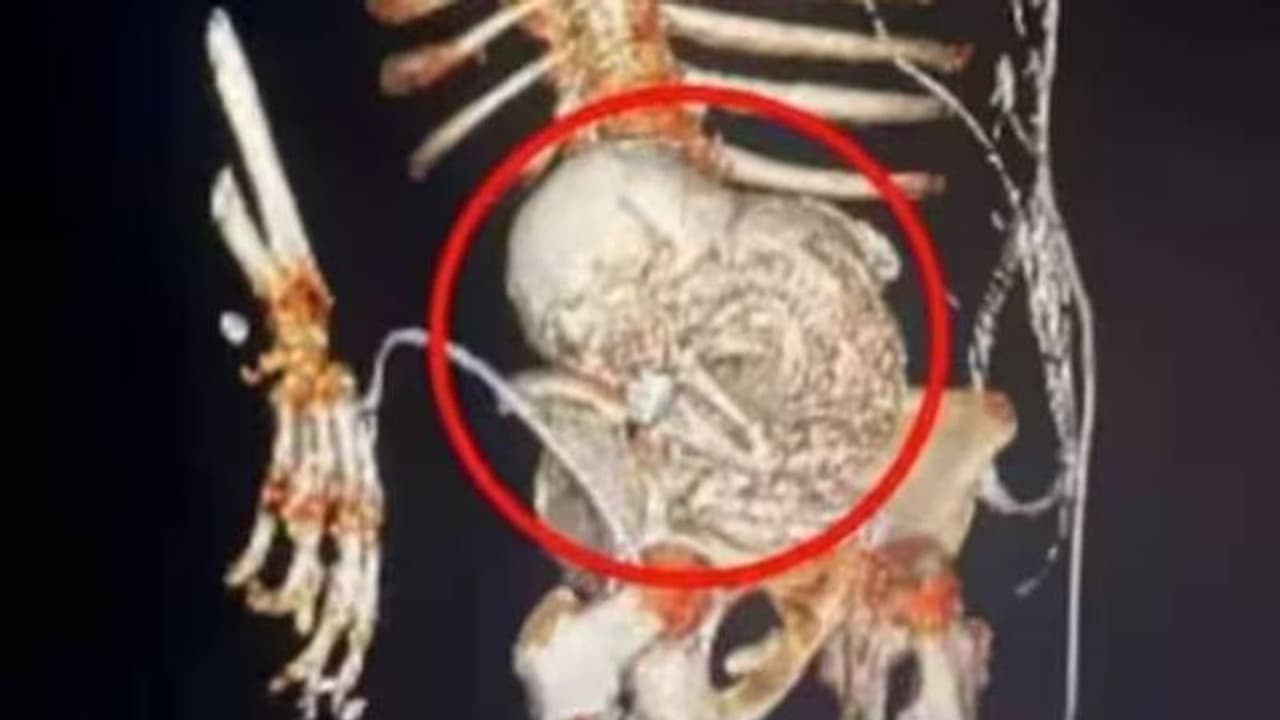 56 വർഷം വയറ്റില്‍ ചുമന്നത് 'സ്റ്റോണ്‍ ബേബി'യെ; സർജറിക്ക് പിന്നാലെ 81 കാരിക്ക് ദാരുണാന്ത്യം