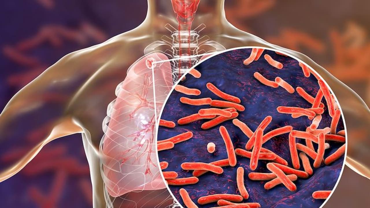 ക്ഷയരോഗികളുടെ എണ്ണം വർദ്ധിക്കുന്നു ; രോഗികളില് 26 ശതമാനവും ഇന്ത്യയില് ക്ഷയരോഗികളുടെ എണ്ണം വർദ്ധിക്കുന്നു ; രോഗികളില് 26 ശതമാനവും ഇന്ത്യയില്