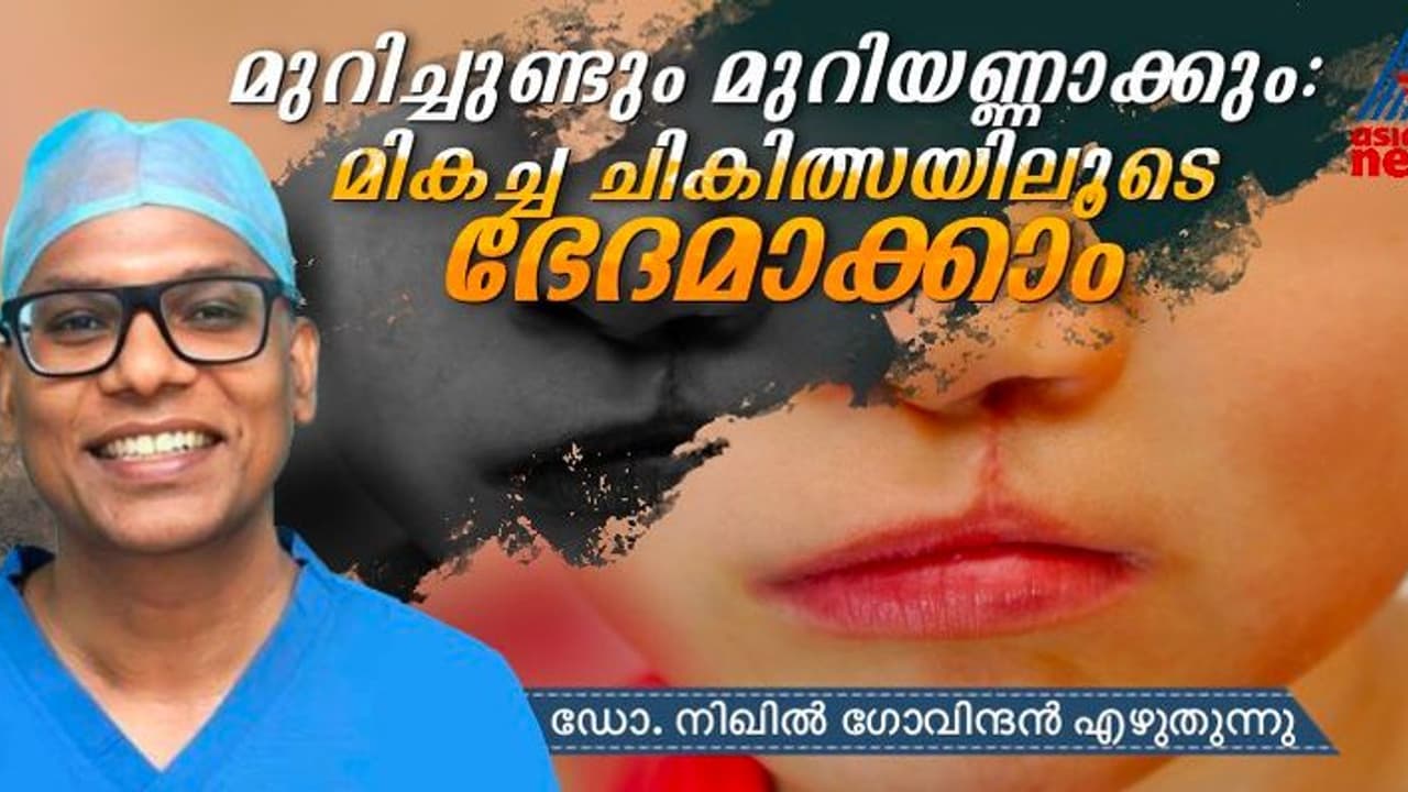 മുറിച്ചുണ്ടും മുറിയണ്ണാക്കും: ആധുനിക ചികിത്സയെ കുറിച്ച് ഡോക്ടര് എഴുതുന്നു... മുറിച്ചുണ്ടും മുറിയണ്ണാക്കും: ആധുനിക ചികിത്സയെ കുറിച്ച് ഡോക്ടര് എഴുതുന്നു...