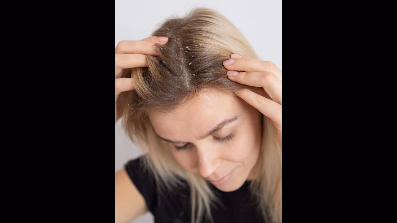 Dandruff remedies: பொடுகுத்தொல்லை இனி இல்லவே இல்லை; சிம்பிள் வீட்டு டிப்ஸ்!!