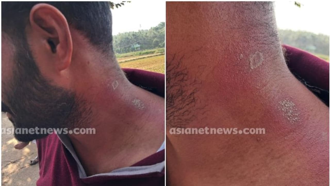 മലപ്പുറത്ത് വീട്ടുവളപ്പില് ജോലി ചെയ്യുന്നതിനിടെ യുവാവിന് സൂര്യാഘാതമേറ്റു മലപ്പുറത്ത് വീട്ടുവളപ്പില് ജോലി ചെയ്യുന്നതിനിടെ യുവാവിന് സൂര്യാഘാതമേറ്റു