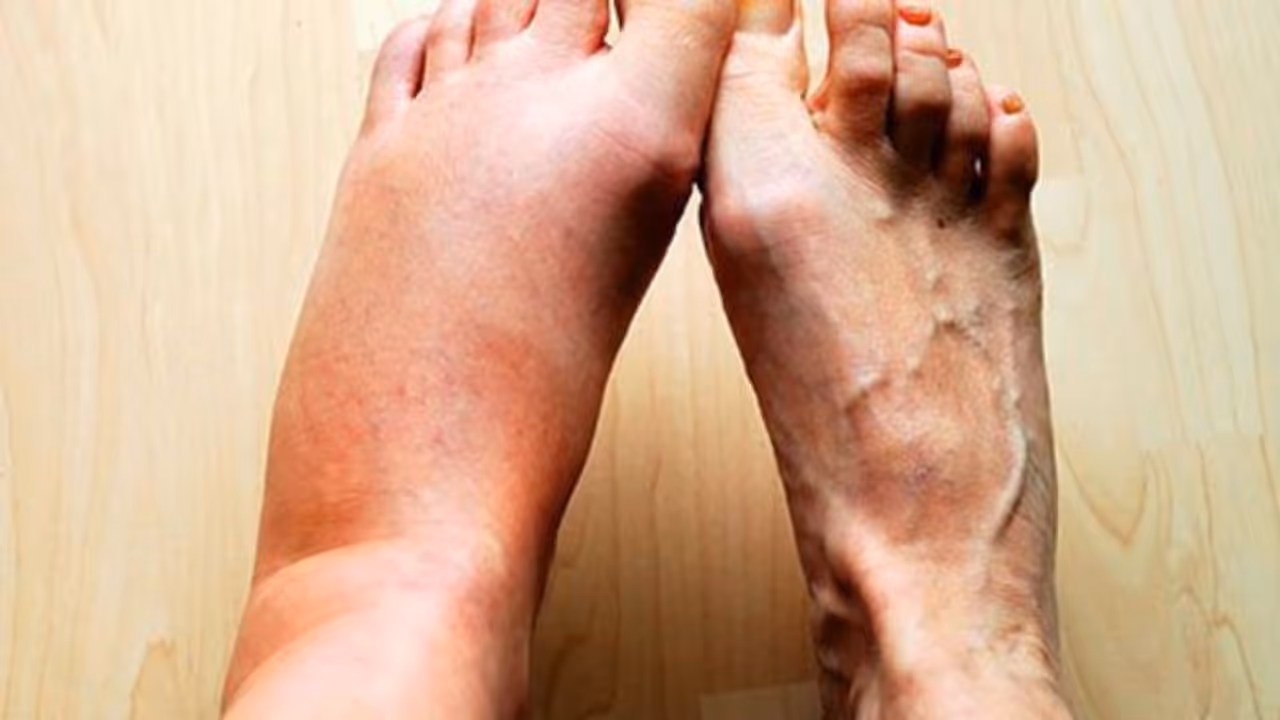 ശരീരത്തിലെ വീക്കം കുറയ്ക്കാൻ സഹായിക്കുന്ന അഞ്ച് പച്ചക്കറികൾ...