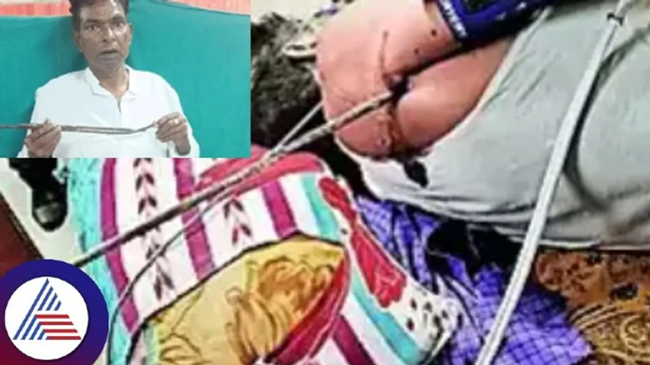 ಹೃದಯಕ್ಕೆ ಚುಚ್ಚಿದ್ದ 75 ಸೆಂಮೀ ಉದ್ದ ಕಬ್ಬಿಣದ ರಾಡ್ ತೆಗೆದ ವೈದ್ಯರು; 54 ವರ್ಷದ ವ್ಯಕ್ತಿಗೆ ಮರುಜನ್ಮ ಹೃದಯಕ್ಕೆ ಚುಚ್ಚಿದ್ದ 75 ಸೆಂಮೀ ಉದ್ದ ಕಬ್ಬಿಣದ ರಾಡ್ ತೆಗೆದ ವೈದ್ಯರು; 54 ವರ್ಷದ ವ್ಯಕ್ತಿಗೆ ಮರುಜನ್ಮ