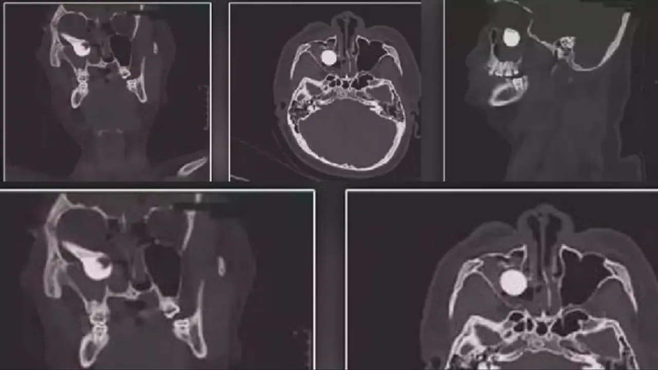 ಅಪಘಾತದ ವೇಳೆ ಕಣ್ಣಿನೊಳಗೆ ನುಗ್ಗಿದ ಬೈಕ್ನ ಬ್ರೇಕ್ ಹ್ಯಾಂಡಲ್ ಹೊರತೆಗೆದ ವೈದ್ಯರು ಅಪಘಾತದ ವೇಳೆ ಕಣ್ಣಿನೊಳಗೆ ನುಗ್ಗಿದ ಬೈಕ್ನ ಬ್ರೇಕ್ ಹ್ಯಾಂಡಲ್ ಹೊರತೆಗೆದ ವೈದ್ಯರು