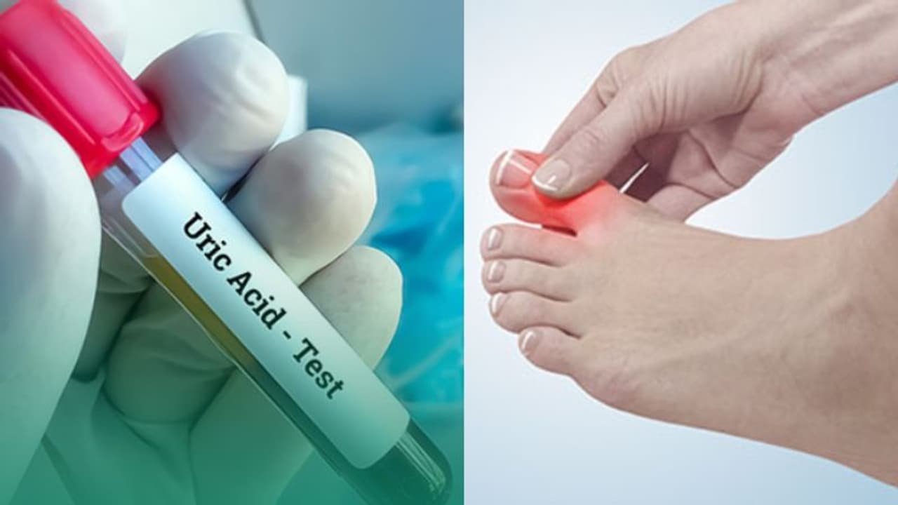 യൂറിക് ആസിഡ് തോത് കുറയ്ക്കാന്‍ വീട്ടില്‍ ചെയ്യേണ്ട കാര്യങ്ങള്‍... 