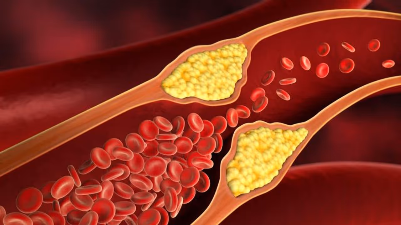 High cholesterol: Know how lifestyle modifications help to reduce high triglyceride levels