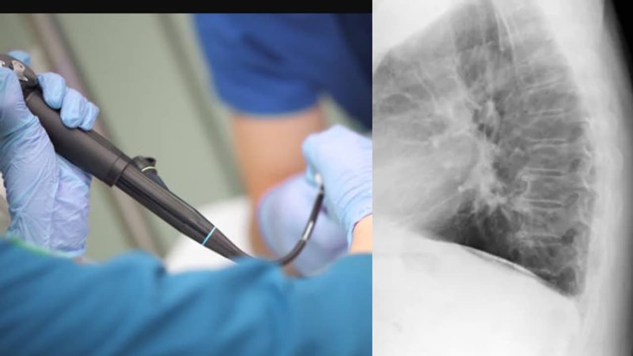  2 വയസുകാരിക്ക് അപസ്മാരമെന്ന് കരുതി, സ്കാനിങ്ങിൽ കാര്യമറിഞ്ഞു, ശ്വാസനാളത്തിൽ കണ്ടത് 1 മാസം പഴക്കമുള്ള കടല