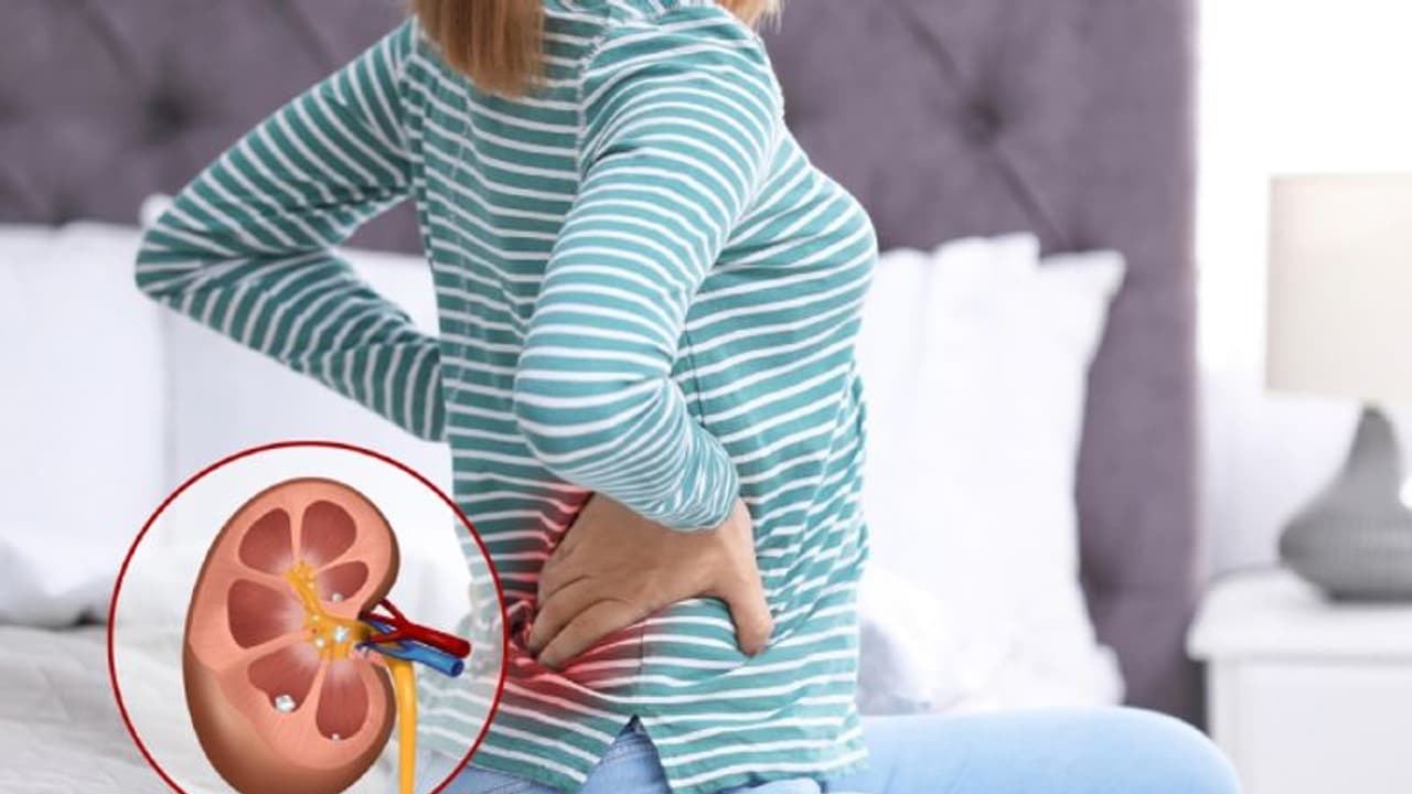 Kidney Stones : உங்களுக்கு சிறுநீரக கற்கள் பிரச்சனையா? அப்ப இந்த உணவுகளை தொட்டு கூட பாக்காதீங்க!