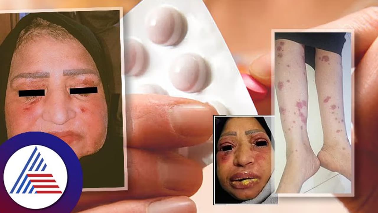 ಡಾಕ್ಟರ್‌ಗೆ ತೋರ್ಸದೇ ಜ್ವರಕ್ಕೆ ಮಾತ್ರೆ ತಗೊಂಡ ಮಹಿಳೆ ಮುಖವೇ ಆಯ್ತು ವಿಚಿತ್ರ!