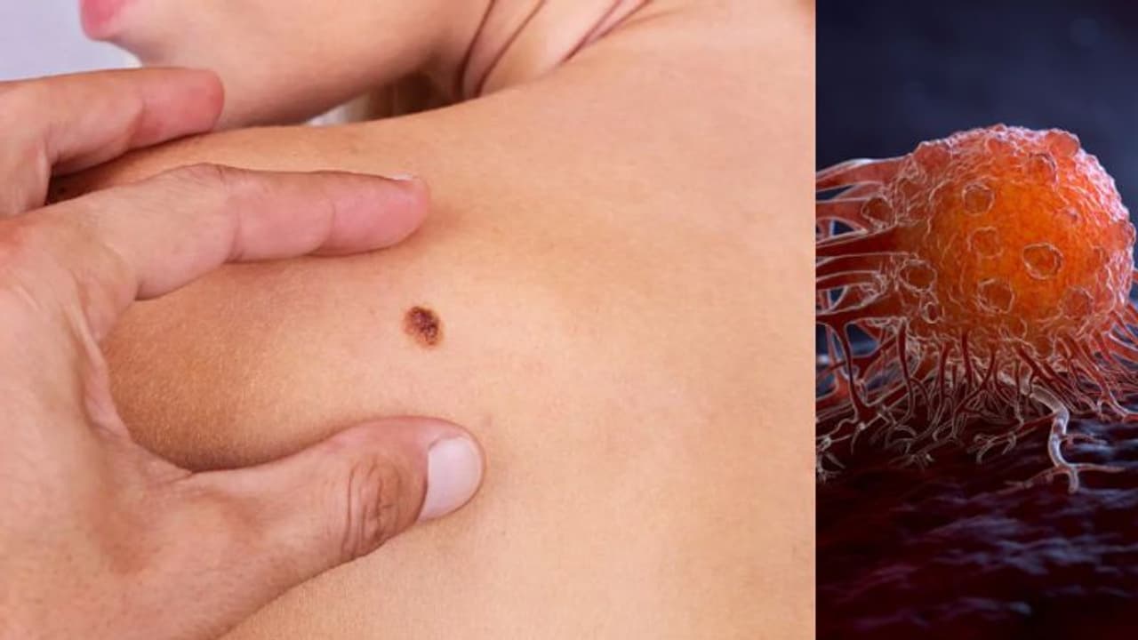 ത്വക്കിലെ അര്‍ബുദം; ശരീരം മുൻകൂട്ടി കാണിക്കുന്ന ലക്ഷണങ്ങൾ... 