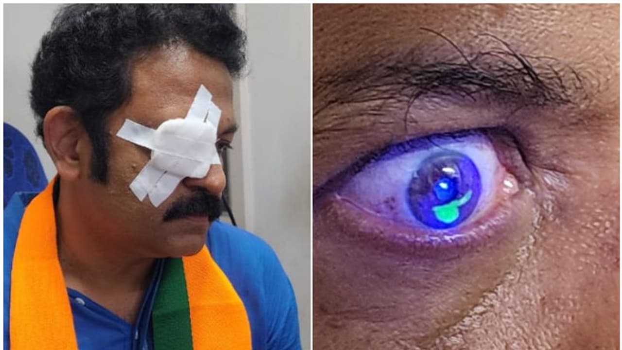 കൊല്ലത്തെ എൻഡിഎ സ്ഥാനാർഥി കൃഷ്ണ കുമാറിന് പ്രചരണത്തിനിടെ പരിക്ക്, സ്വീകരണത്തിനിടെ കണ്ണിൽ കൂർത്ത വസ്തു കൊണ്ടു കൊല്ലത്തെ എൻഡിഎ സ്ഥാനാർഥി കൃഷ്ണ കുമാറിന് പ്രചരണത്തിനിടെ പരിക്ക്, സ്വീകരണത്തിനിടെ കണ്ണിൽ കൂർത്ത വസ്തു കൊണ്ടു