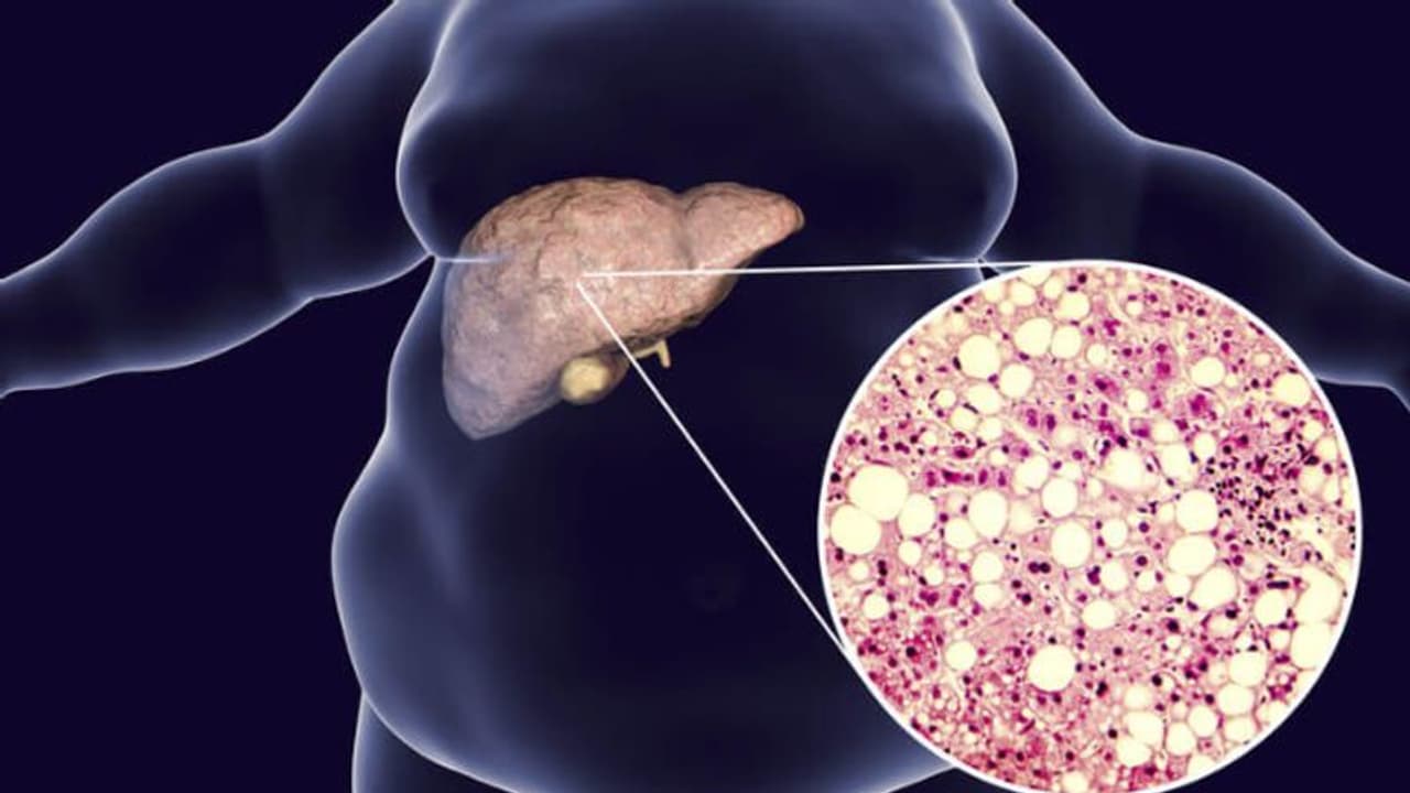 ശരീരത്തിലെ ഈ ഭാഗങ്ങളിലെ നീര്ക്കെട്ട് ഫാറ്റി ലിവര് രോഗത്തിന്റെ സൂചനയാകാം; അവഗണിക്കരുത് ശരീരത്തിലെ ഈ ഭാഗങ്ങളിലെ നീര്ക്കെട്ട് ഫാറ്റി ലിവര് രോഗത്തിന്റെ സൂചനയാകാം; അവഗണിക്കരുത്