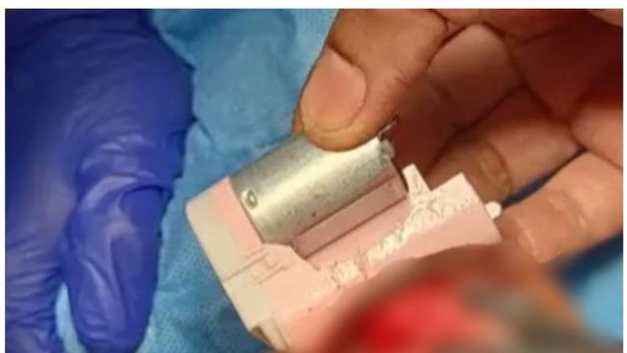 വൈബ്രേറ്റ് ചെയ്യുന്ന വിദേശ നിർമിത നഖംവെട്ടി നാല് വയസുകാരന്റെ നാവിൽ കുടുങ്ങി; പുറത്തെടുത്തത് ശസ്ത്രക്രിയയിലൂടെ വൈബ്രേറ്റ് ചെയ്യുന്ന വിദേശ നിർമിത നഖംവെട്ടി നാല് വയസുകാരന്റെ നാവിൽ കുടുങ്ങി; പുറത്തെടുത്തത് ശസ്ത്രക്രിയയിലൂടെ