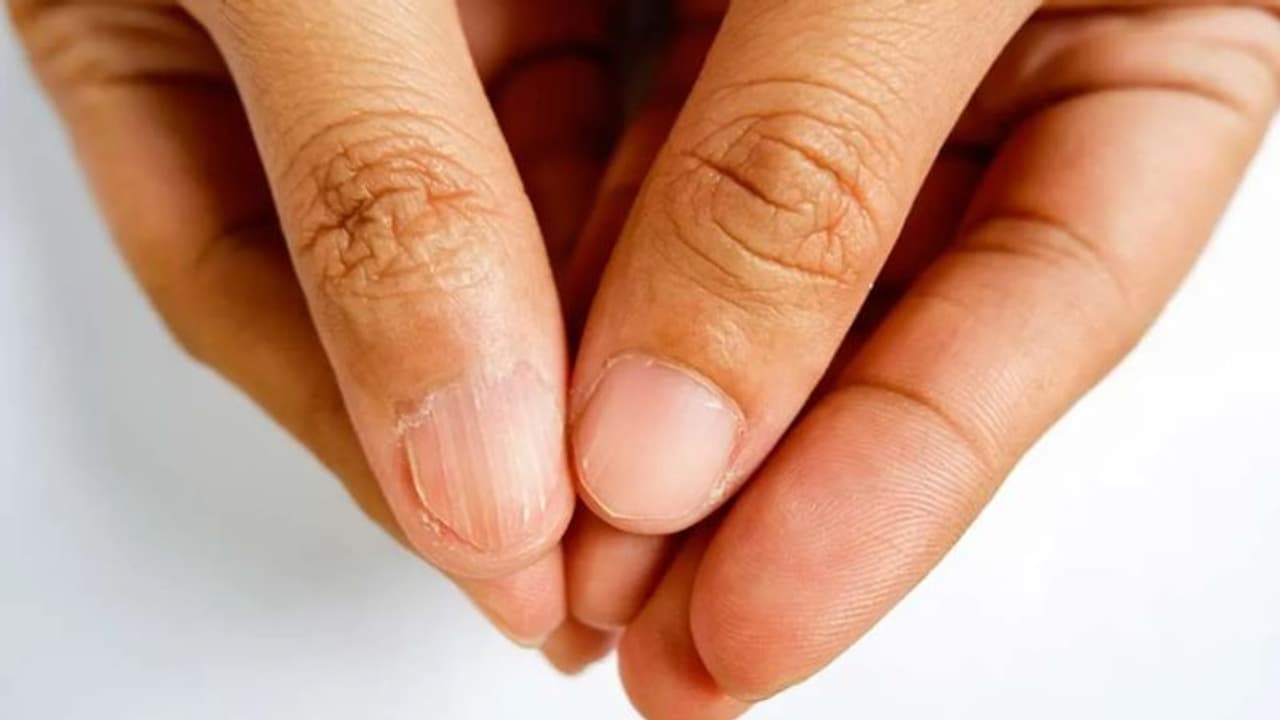 Health Tips: പ്രോട്ടീൻ കുറവാണോ? ശരീരം സൂചിപ്പിക്കുന്ന ഈ ലക്ഷണങ്ങളെ അവഗണിക്കരുത്