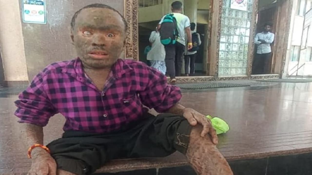 ಅಂದಗೆಟ್ಟ ದೇಹ: ಆಧಾರವಿಲ್ಲದೆ ಜೀವನವೇ ದುಸ್ತರ, ಕರುಣಾಜನಕ ಸ್ಥಿತಿಯಲ್ಲಿರುವ ಯುವಕ..! ಅಂದಗೆಟ್ಟ ದೇಹ: ಆಧಾರವಿಲ್ಲದೆ ಜೀವನವೇ ದುಸ್ತರ, ಕರುಣಾಜನಕ ಸ್ಥಿತಿಯಲ್ಲಿರುವ ಯುವಕ..!